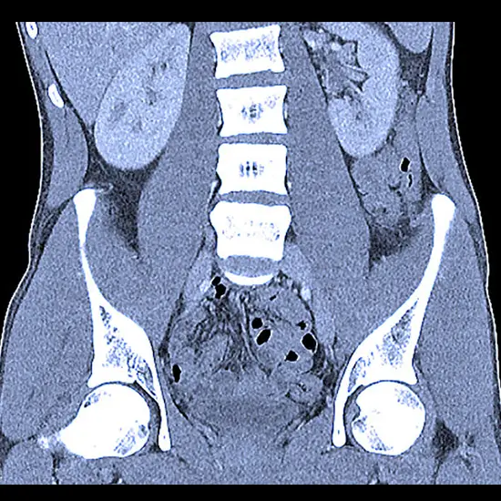 Computerised Tomography (CT) Urography Test